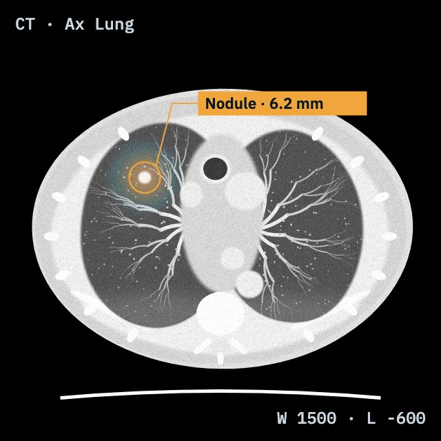 Chest CT with an AI-detected nodule