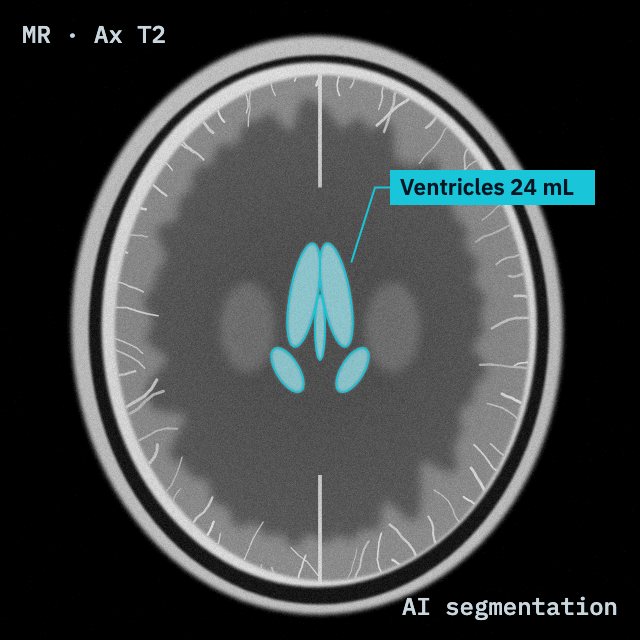 Brain MR with AI segmentation of the ventricles